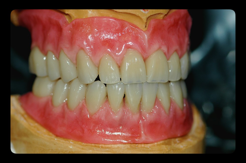 Partial Dentures Procedure Dazey ND 58429